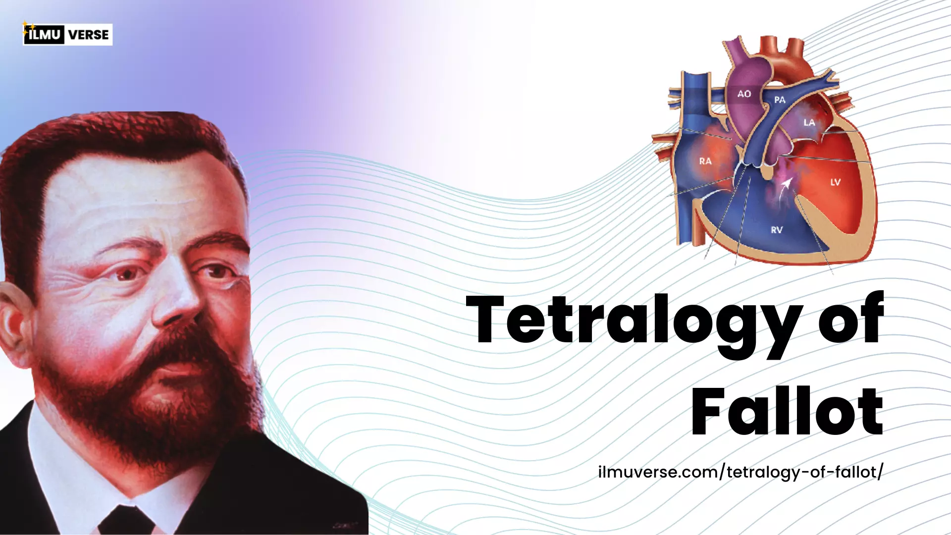 Apa itu Tetralogy of Fallot? Penjelasan singkat dan sederhana mengenai 4 kelainan jantung kongenital