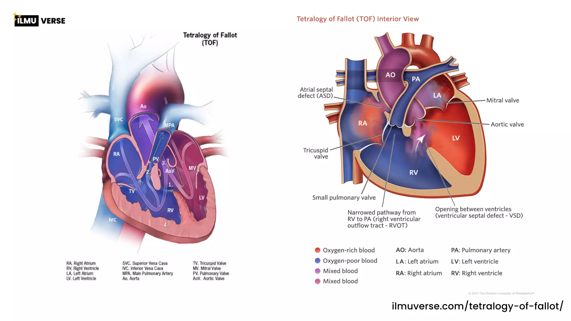 Gambaran Anatomis Tetralogy of Fallot Gambaran Anatomis Tetralogy of Fallot